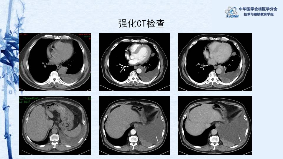 病例18:胸腺瘤pet-ct显像一例-【csnm继教学组】李凤岐