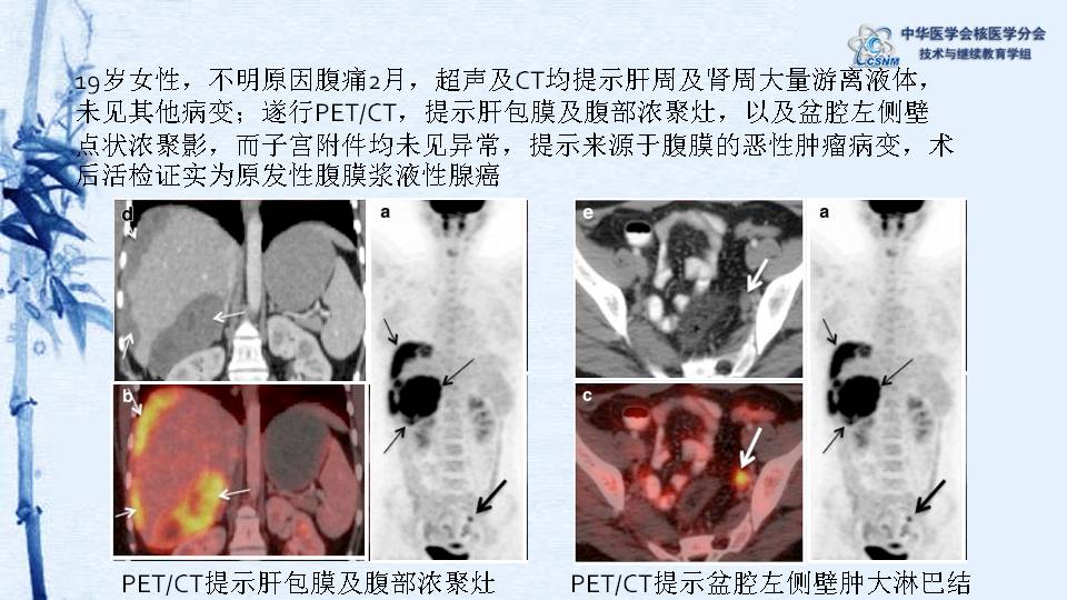 病例11:fdg pet ct诊断原发性腹膜癌病例-【csnm继教学组】黄谋清