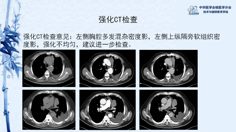 病例18:胸腺瘤pet-ct显像一例-【csnm继教学组】李凤岐