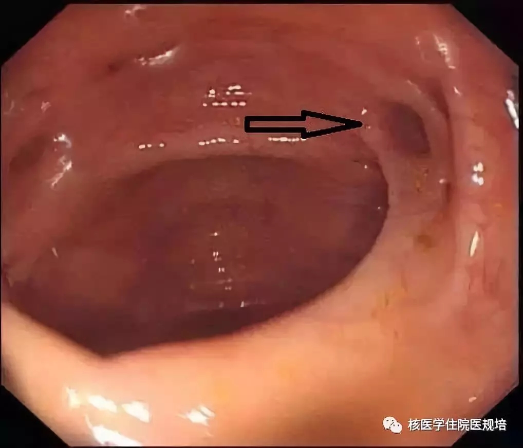 (113)乙状结肠憩室与i-131全身显像中的假阳性