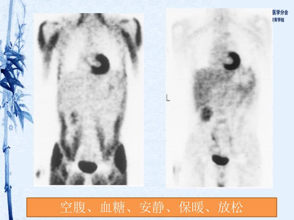 中华医学会核医学分会 讲座 讲座40：PET/CT图像判读和报告规范-姚稚明