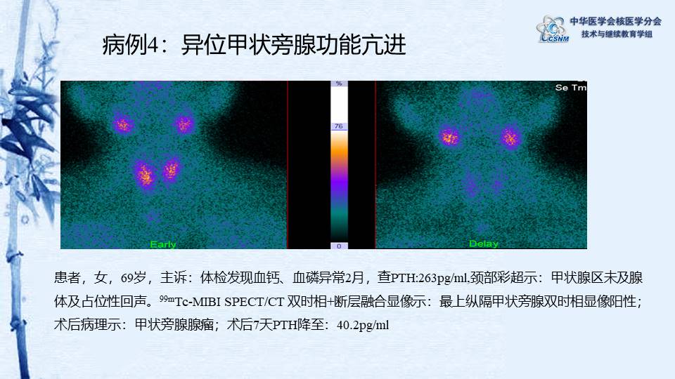 中华医学会核医学分会 讲座 讲座42：甲状旁腺显像临床应用-程兵