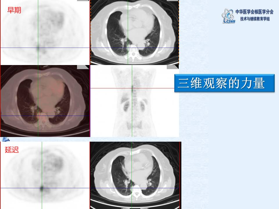 中华医学会核医学分会 讲座 讲座40：PET/CT图像判读和报告规范-姚稚明