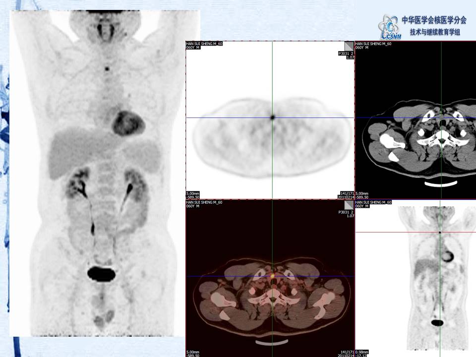 中华医学会核医学分会 讲座 讲座40：PET/CT图像判读和报告规范-姚稚明