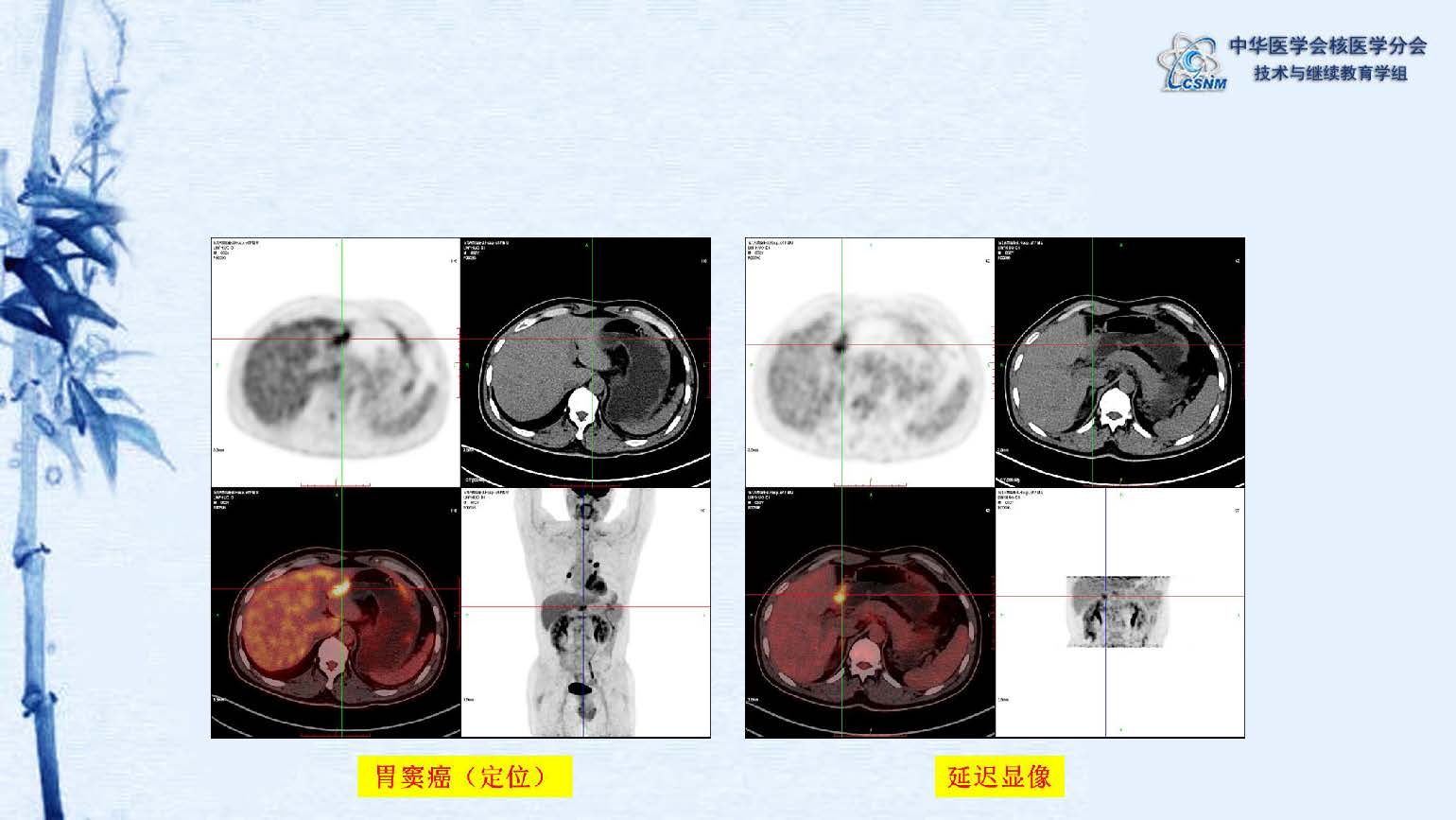 中华医学会核医学分会 讲座 讲座22：PET/CT的图像采集和后处理技术-郑山
