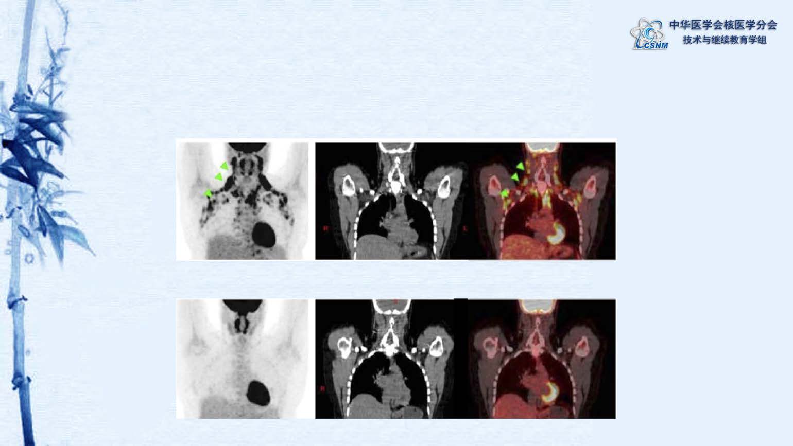 中华医学会核医学分会 讲座 讲座22：PET/CT的图像采集和后处理技术-郑山