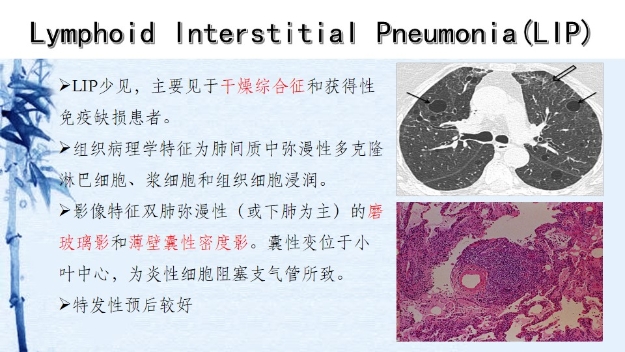 【csnm继教学组】讲座e12 李原 pet/ct在间质性肺病诊治中应用